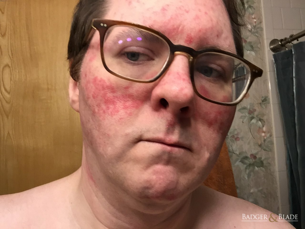 Forum rosacea Return of